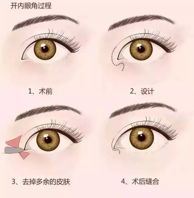 打死都不开眼角，然后我的双眼皮做成了这样~
