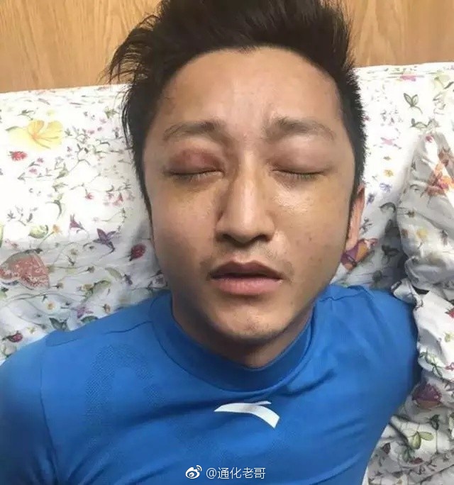 专家:邹市明眼疾严重,视力已达到残疾人标准,不再适合