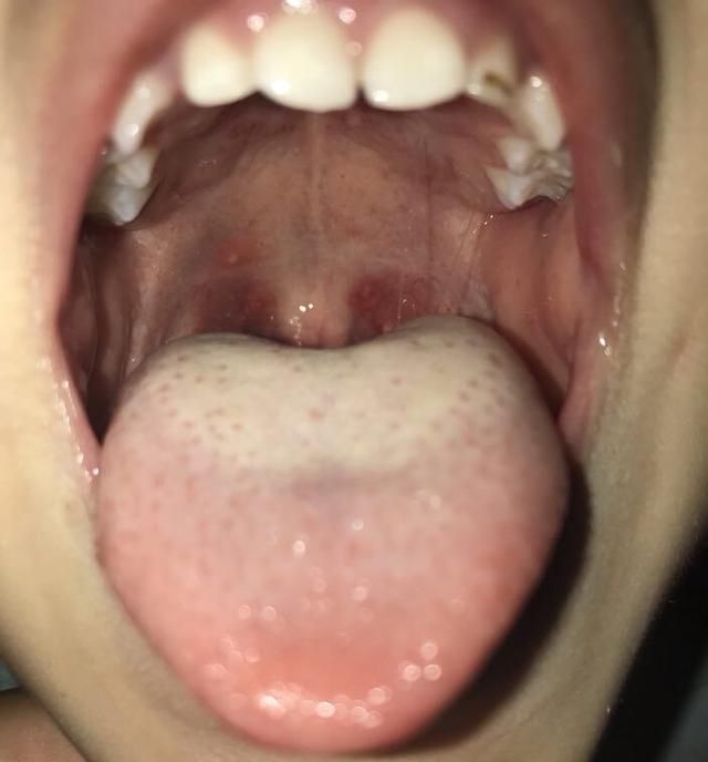 崔玉涛大夫告诉我们疱疹性咽颊炎用抗生素一点道理都没有