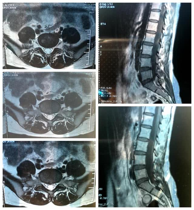 病例3:腰疼 小腿疼 尾椎骨疼是腰椎间盘突出了吗?