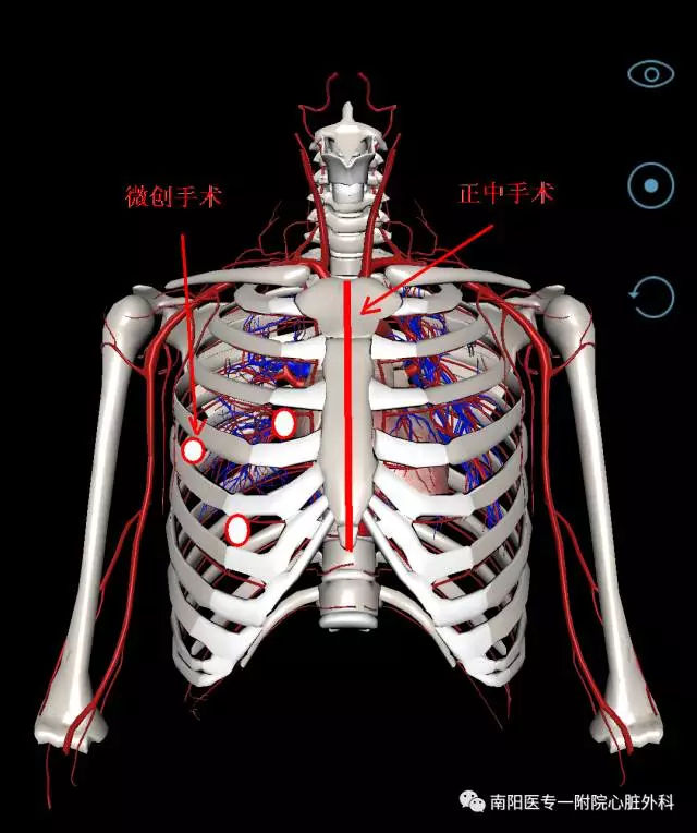 南阳医专一附院心脏手术全面进入微创时代——全胸腔