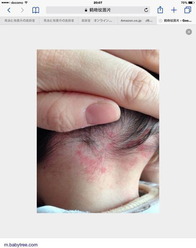 小宝宝后脑勺和脖子后面有红斑是怎么回事?