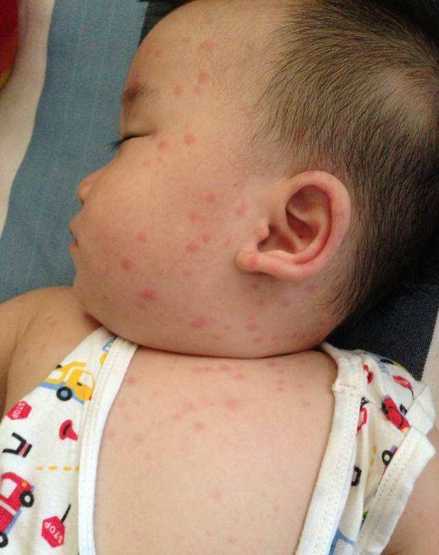 六个月后宝宝第一次高烧,是幼儿急疹?别惊慌,