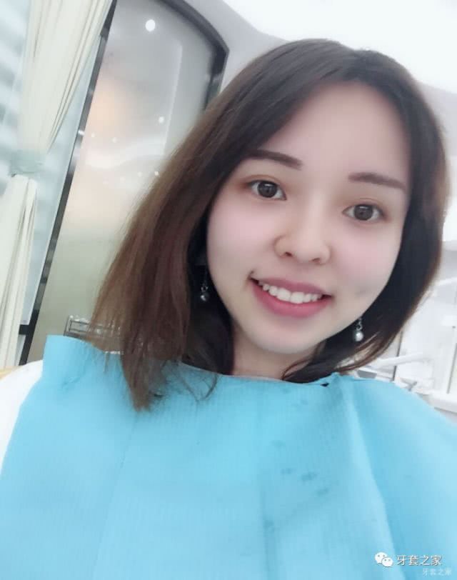 门牙过大,二次矫正,咬合非常不正常