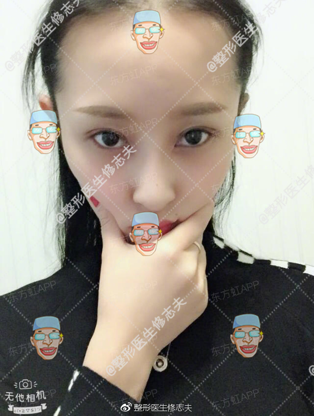 歪鼻修复术后40天恢复日记:从沮丧煎熬到欣喜