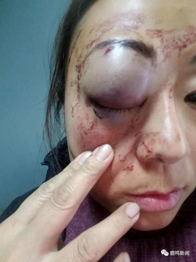 女子医院看病和护士发生争执 伤及眼睛,一只眼肿胀如