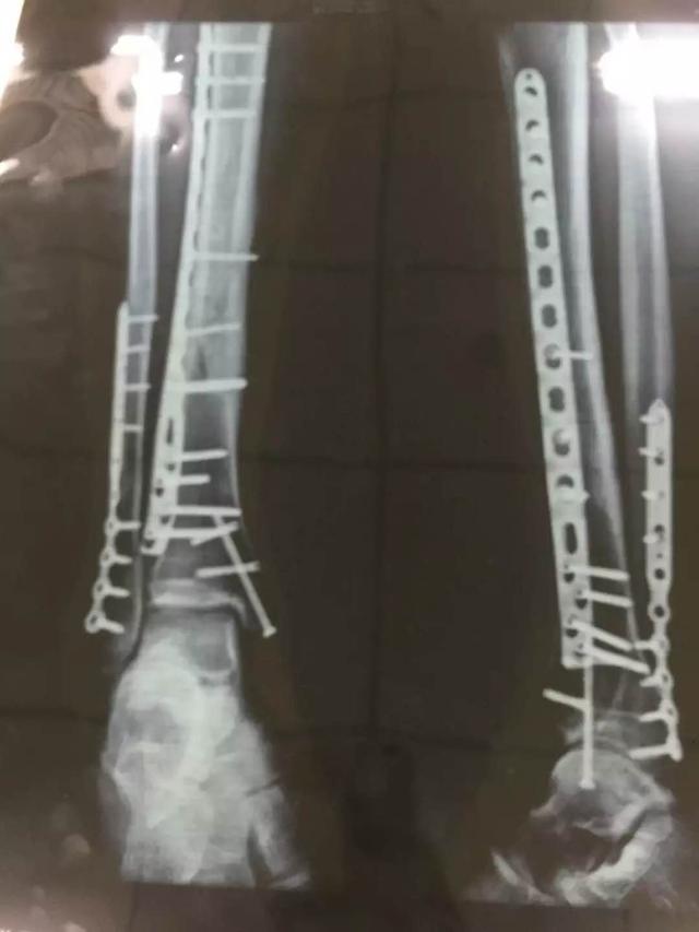贾宗洋在双腿骨折后,做了手术,用四个钢板固定住了双腿,一直没有取出