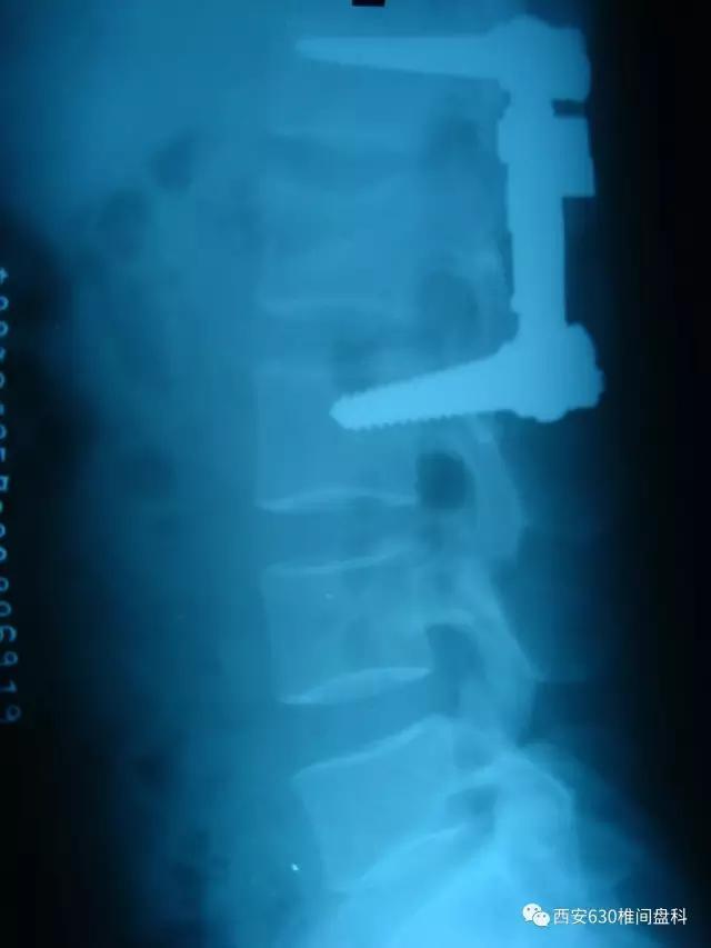 压缩性骨折是什么意思?