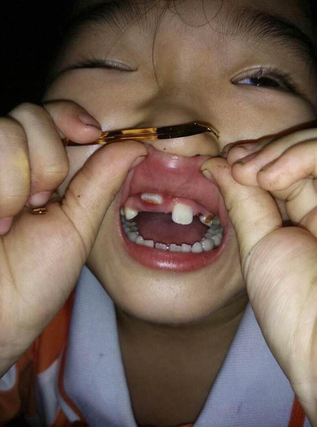 孩子天天吃这种食物,结果导致口腔发黑,最后患上口腔癌!
