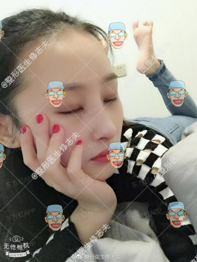 歪鼻修复术后40天恢复日记:从沮丧煎熬到欣喜