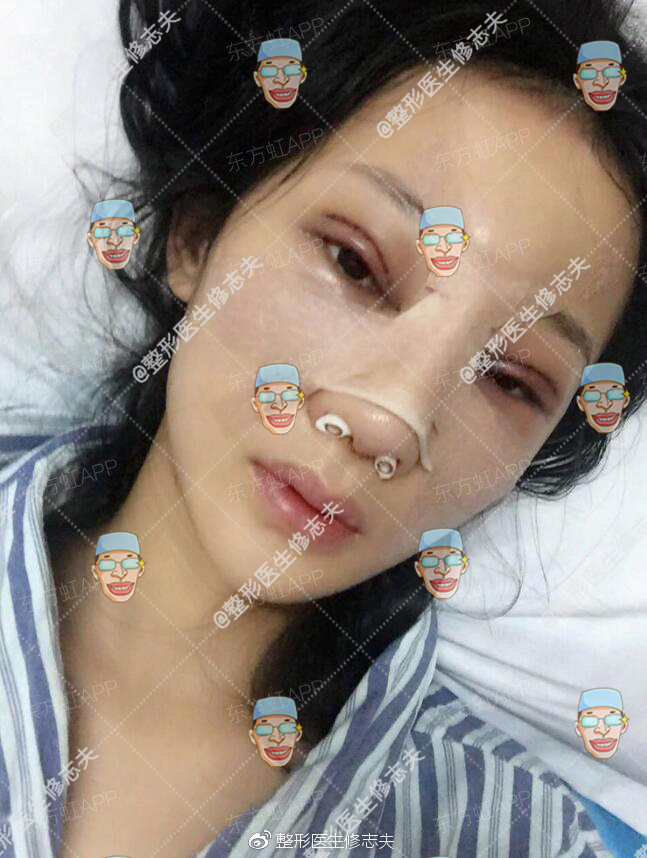 歪鼻修复术后40天恢复日记:从沮丧煎熬到欣喜