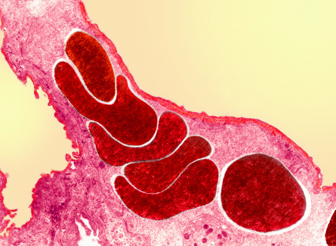 少了一个肾还能活多久?正确答案很可怕