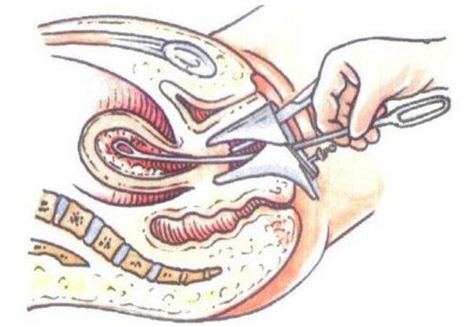 女性取环的过程需要多长的时间,取环的过程会