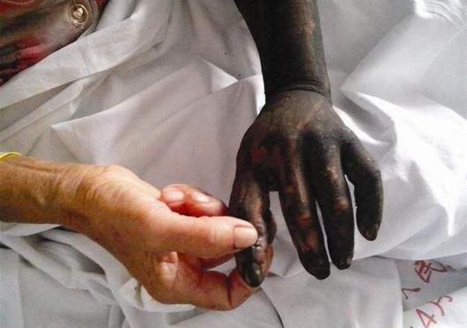 家里发现一条剧毒蛇,不小心被毒蛇咬后怎么办?极速急救护命法!