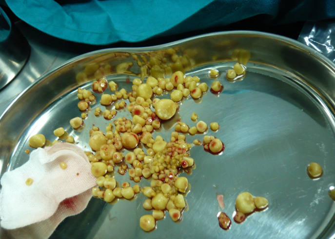 东人最喜欢拿来煲汤的草根,竟是消除肾结石的