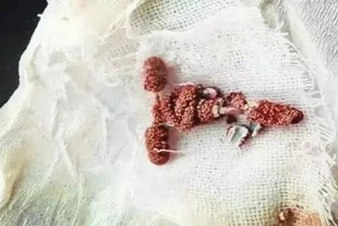 同样是"上环", 有些女性为啥就不适应