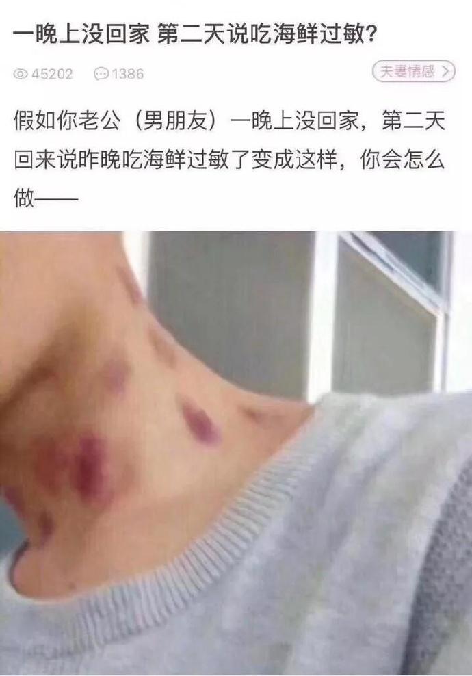 假如你的老公一夜未归,说脖子上的印记是海鲜过敏,你
