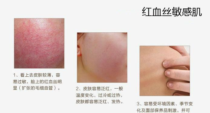 脸上有红血丝发红发烫用什么好 脸发红发烫要