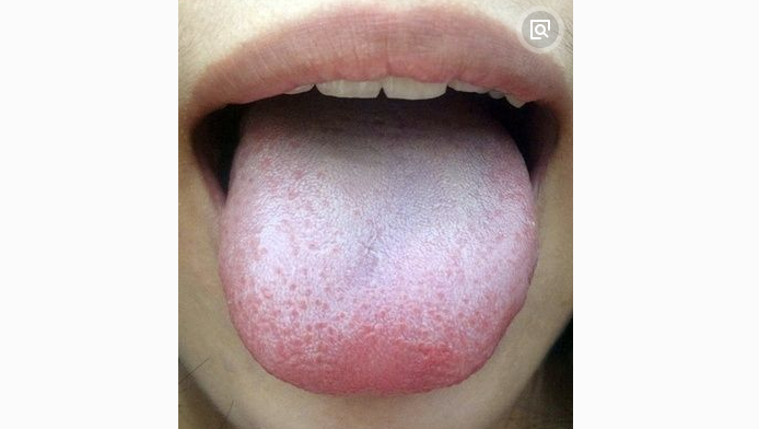 我们舌苔有时白厚,有时舌苔很少!其背后的原因