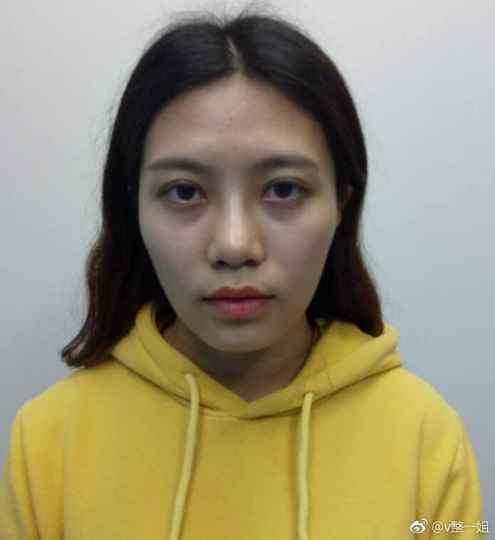 北京自体脂肪填充全脸案例分享,术前术后一个