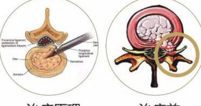 友分享腰间盘突出的中药方法,缓解腰疼腿疼,从