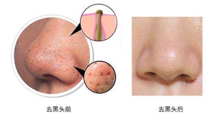 黑头粉刺怎么去除最好, 粉刺从此拜拜