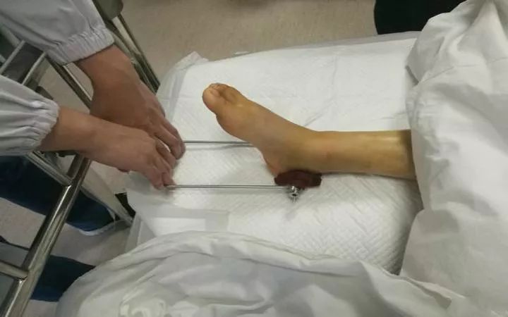 常州一女子带小孩坐滑梯,脚踝3处骨折!更悲催的是