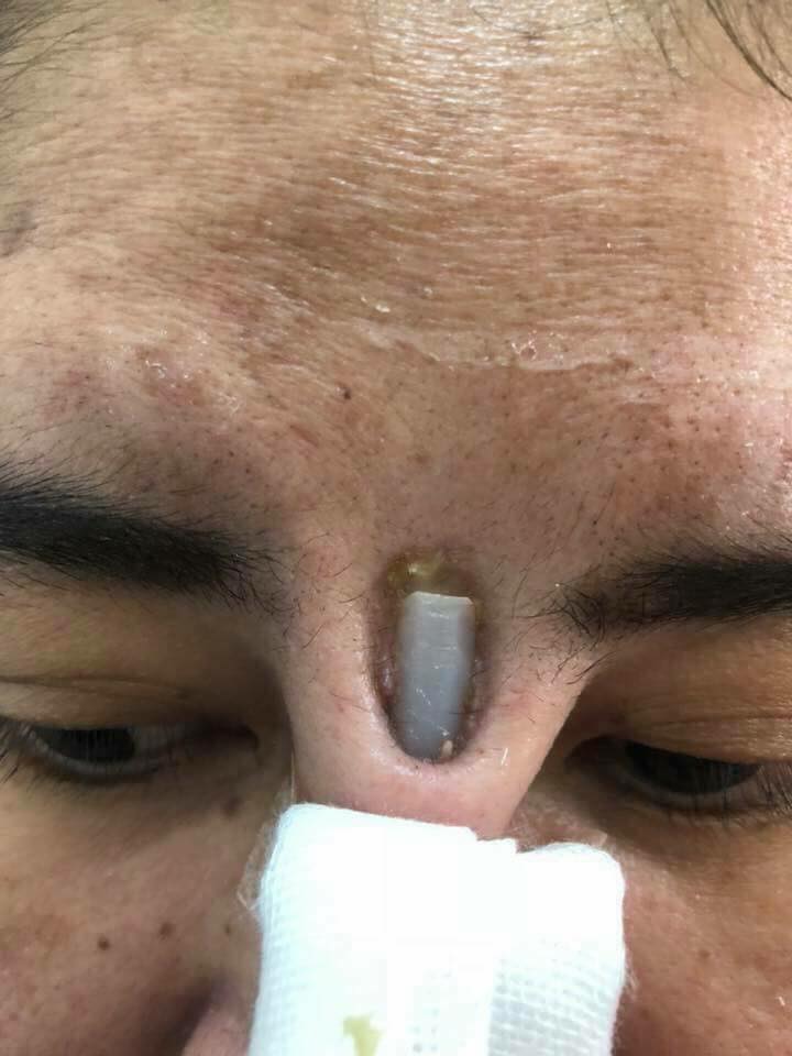 廉价隆鼻几天后"假体贯穿鼻梁外露发炎,硅胶拿出便宜到吓人!