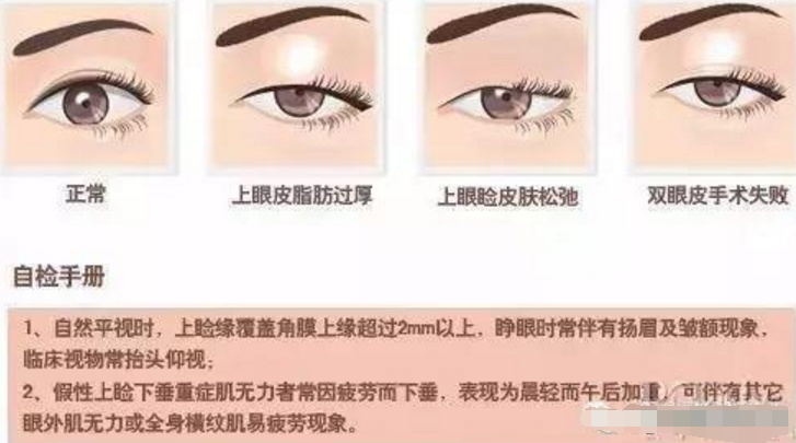 上睑下垂