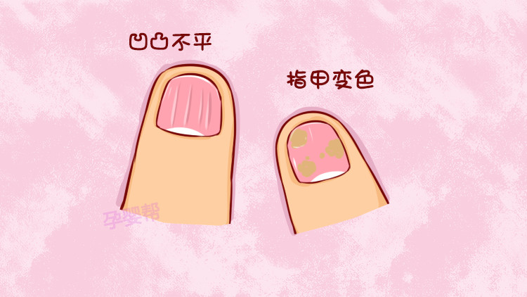 宝宝感染灰指甲的2大初期症状,90%的家长都会