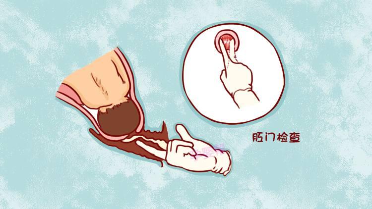 检查,医生在戴着无菌手套的情况下,从阴道将手指伸入,将手指放在子宫