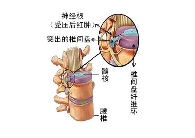 腰间盘突出千万不要再手术了，否则会影响一生！不要傻着做手术了