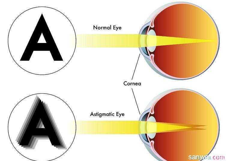正文   散光是指平行光线经过眼球屈光系统折射后,并不聚为单一点