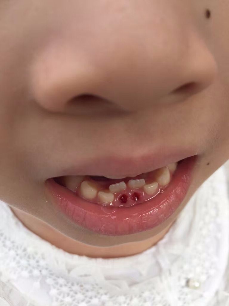 育儿:妈妈的错误喂养习惯,导致9岁孩子乳牙滞留长出双排牙