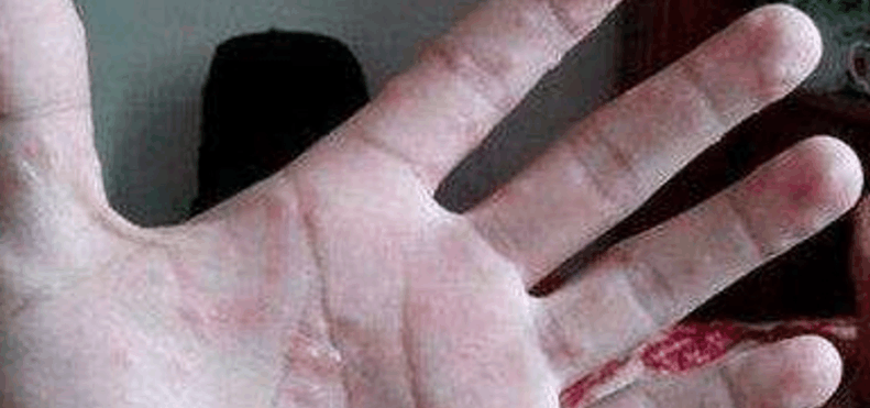 手上长出透明的小水泡, 而且又疼又痒怎么办?