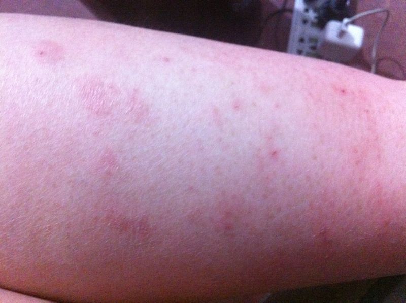 孕妇小腿痒的厉害是怎么回事?该怎么办?!