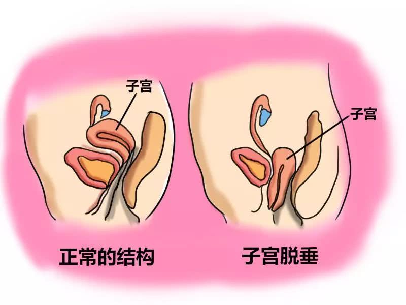 子宫脱垂重度可能会影响到膀胱和直肠功能,表现为排尿或者排便困难,有