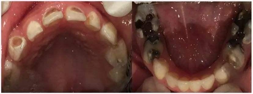 总是担心孩子牙齿坏掉,这7个问题一定不能忽视|宝宝|蛀牙|孩子_新浪网