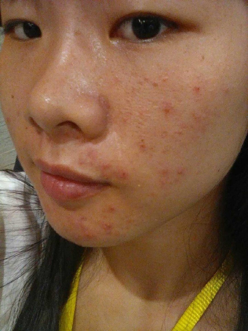 家里常见的小"物,十天除螨祛痘淡化痘印