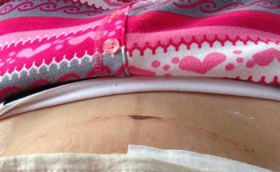 为什么林心如杨幂等女明星都选择剖腹产?知道