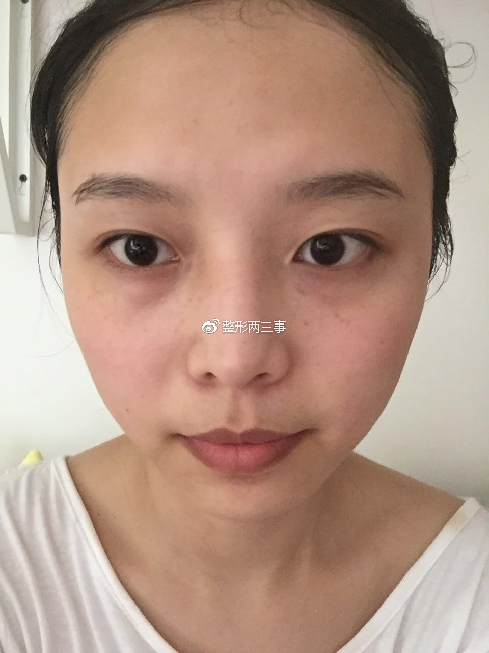 成都双眼皮加内切眼角恢复日记 终于告别了眯眯眼