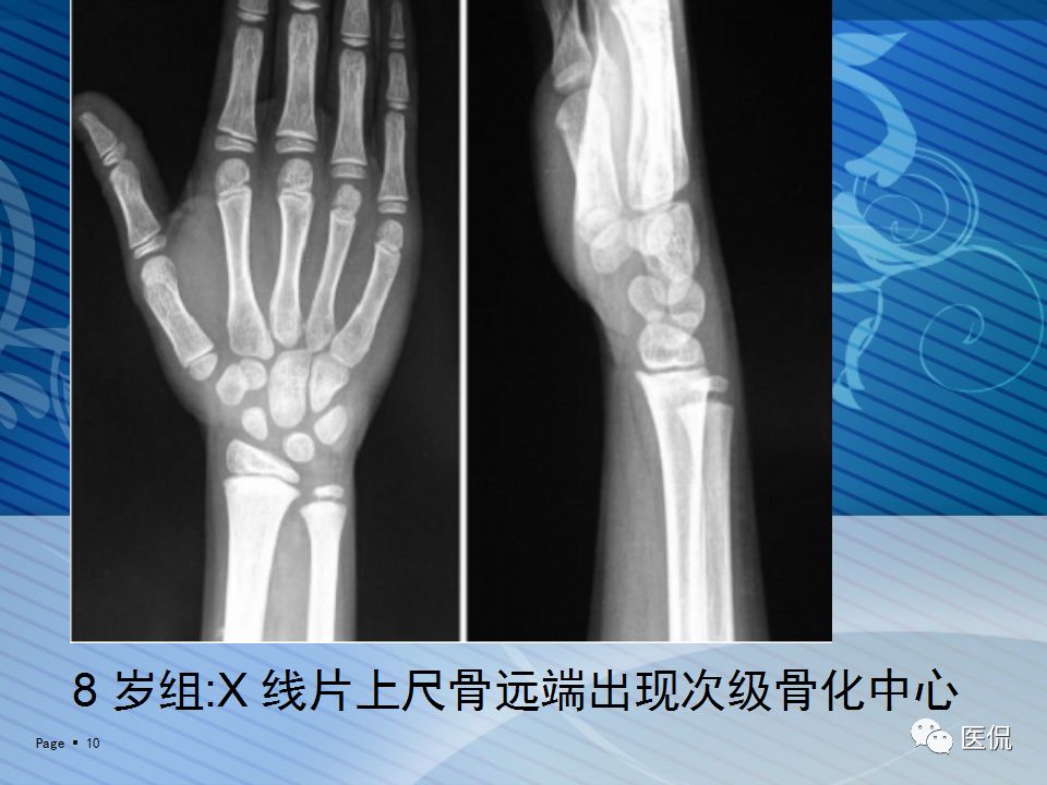 x光看未成年人上肢骨化中心的出现时间#医学影像经典ppt