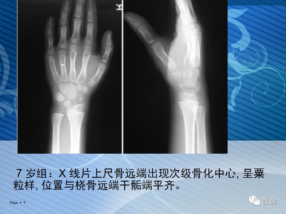 x光看未成年人上肢骨化中心的出现时间#医学影像经典ppt