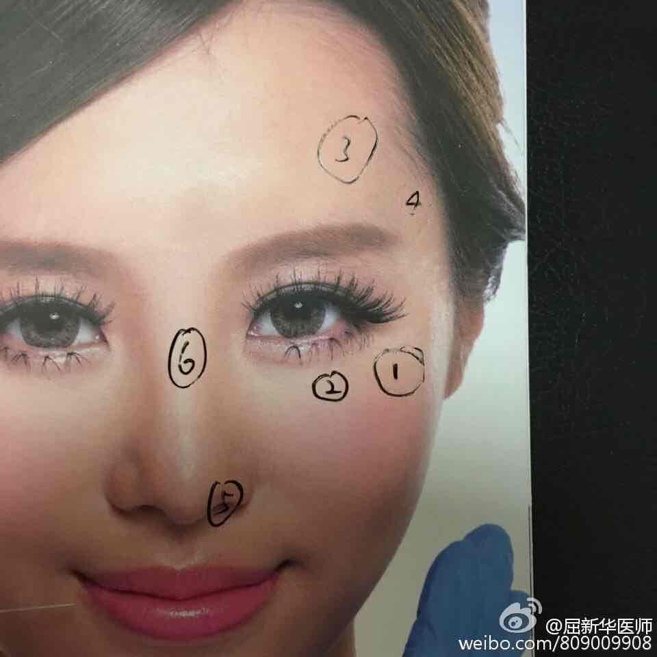 褐青色痣的最好治疗方法