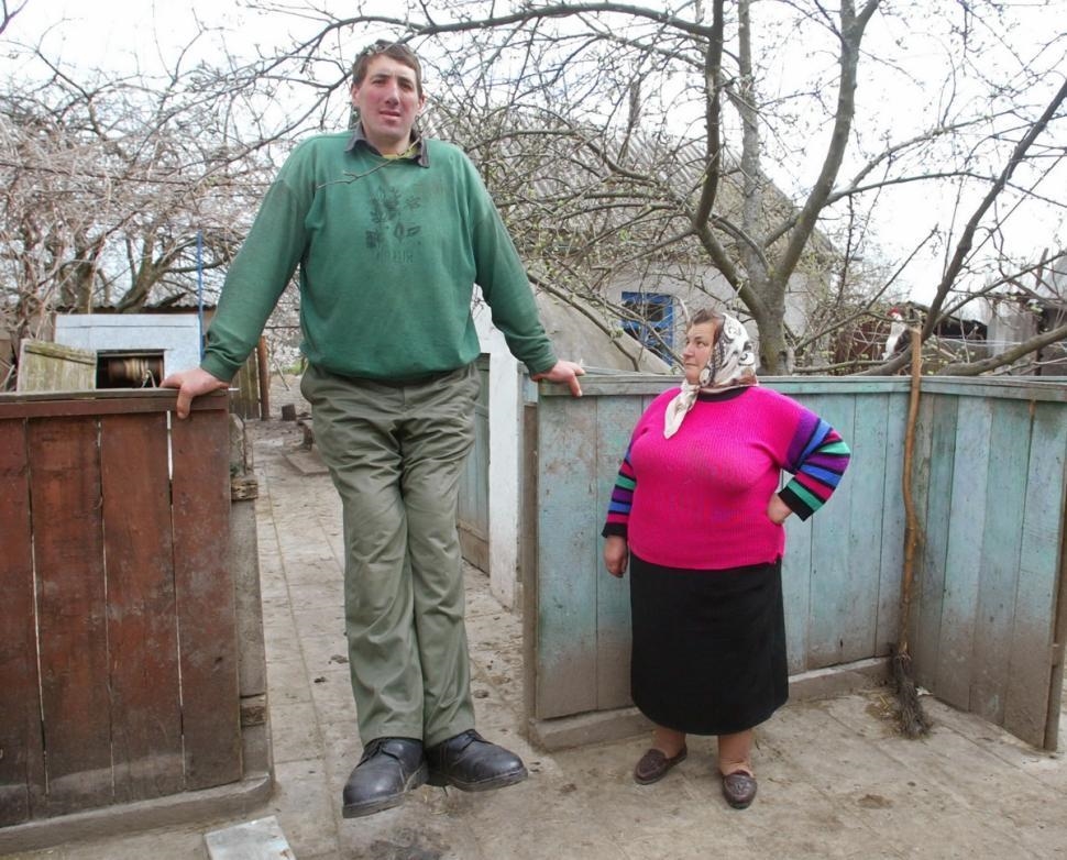 第一高人乌克兰男子因患巨人症 3年长高30厘米