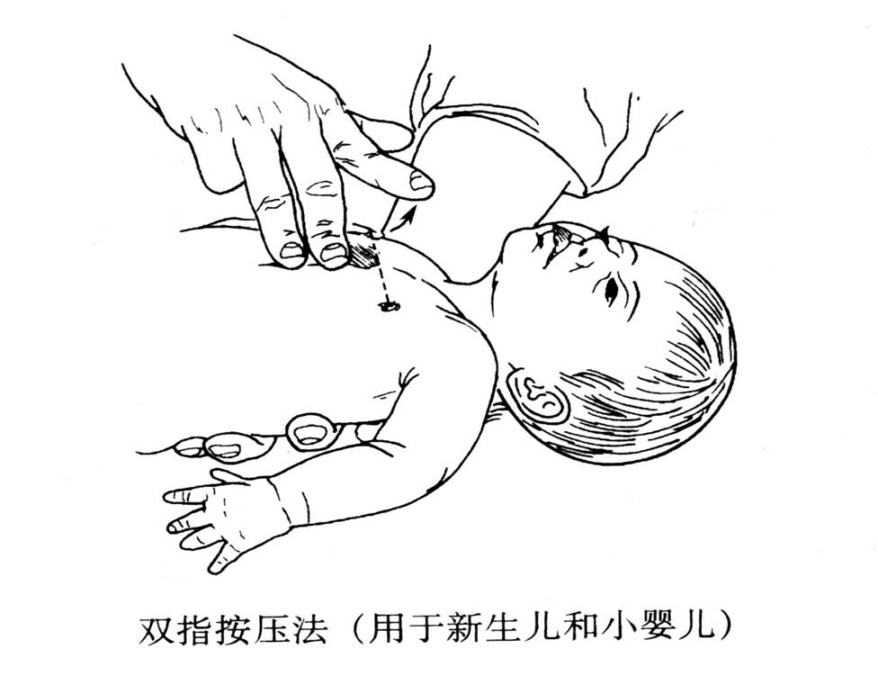 小儿心肺复苏急救法
