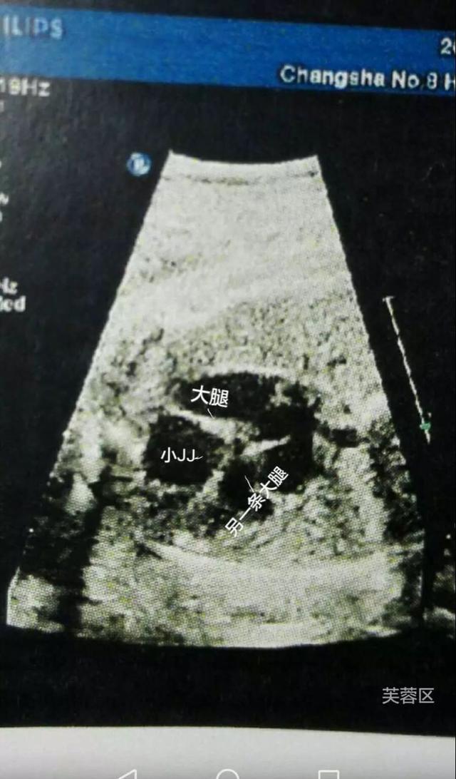 B超竟然看到男宝特征了, 确定怀了儿子, 男宝症