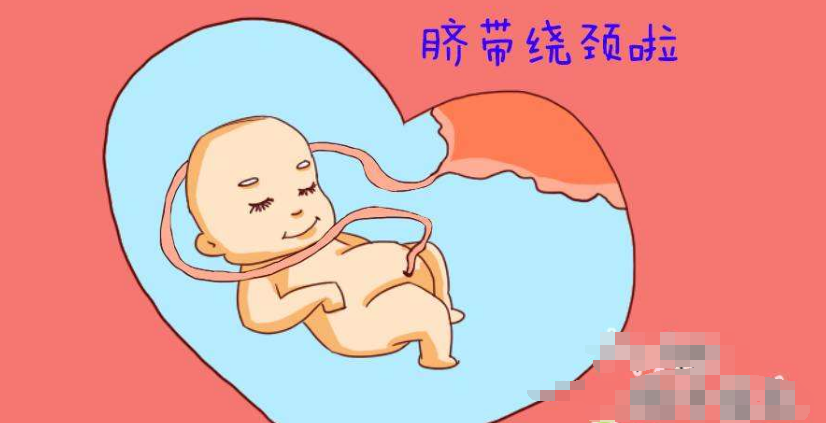 如果你怀孕了,胎儿脐带绕颈三周有危险吗?如何