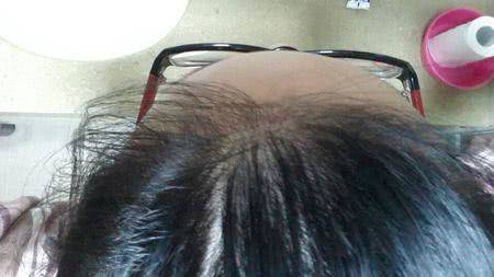 头皮里面长疙瘩还流脓怎么办?给你支个妙招