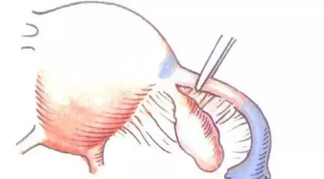 90%的宫腔粘连与这个有关,备孕女性一定要看!
